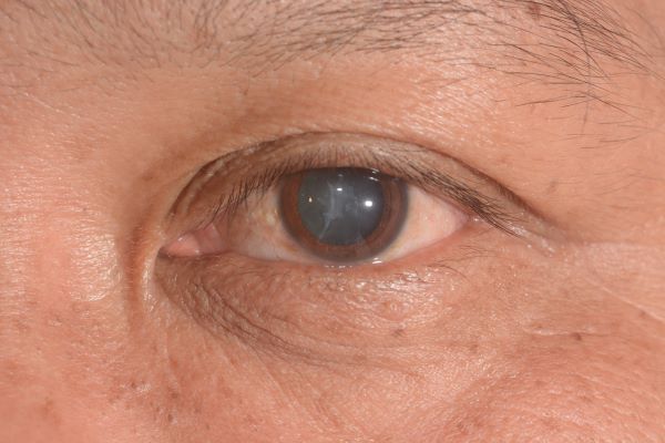 Cataract Surgery And Dry Eye Disease (DED)